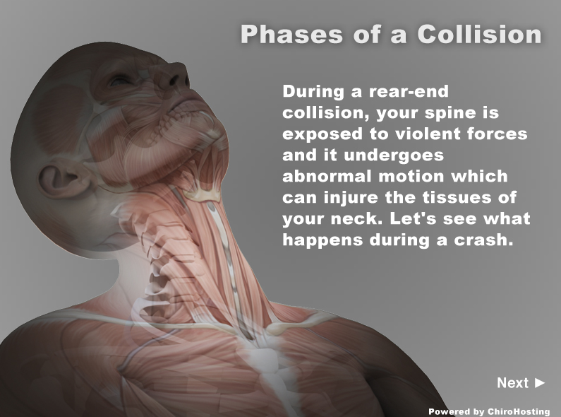 Phases of a Whiplash Injury